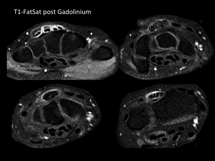 Figure 2 for case 4th extensor compartment tendinosis and stenosing tenosynovitis